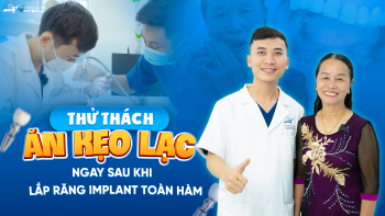 Ăn kẹo lạc ngay sau khi lắp răng implant toàn hàm – Hạnh phúc vỡ òa