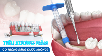 trồng răng khi bị tiêu xương hàm