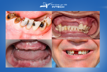 Khi nào nên trồng răng Implant? 4 lưu ý trước khi trồng răng