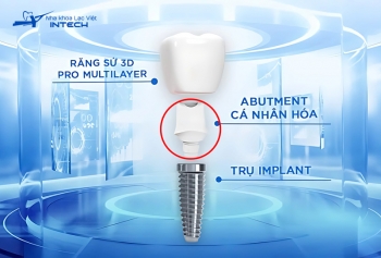 Giới thiệu cấu tạo trụ Implant với 3 bộ phận quan trọng