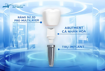 Bác sĩ giải đáp: “Trồng răng Implant có được vĩnh viễn không?” 