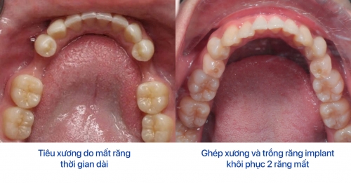 5 Dấu hiệu tiêu xương răng dễ nhận biết nhưng bị bỏ qua