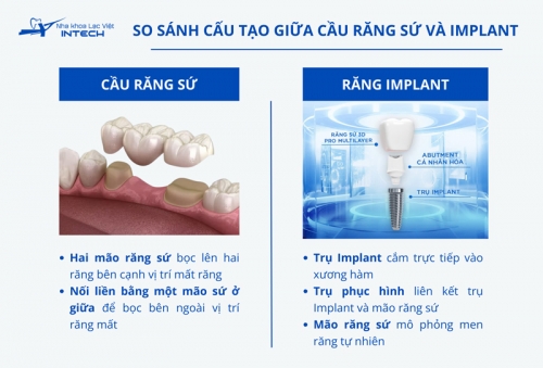 6 điểm khác biệt giữa cầu răng sứ và Implant: Nên chọn phương pháp nào? 