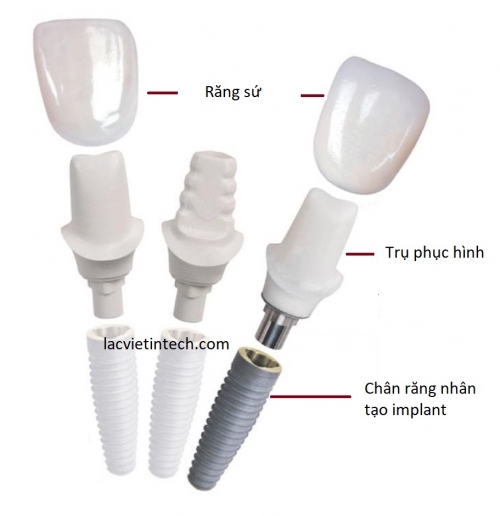 Giải pháp trồng răng implant cá nhân hóa DCT - trồng một lần, an tâm sử dụng trọn đời.