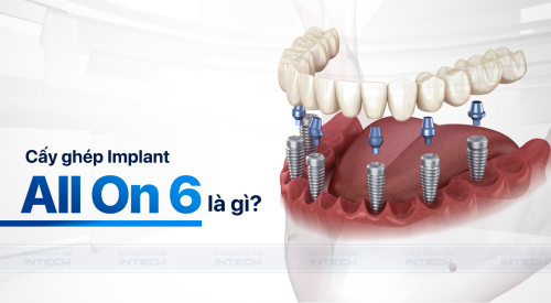 Cấy ghép Implant All - On- 6 là gì? Quy trình thực hiện như thế nào? 