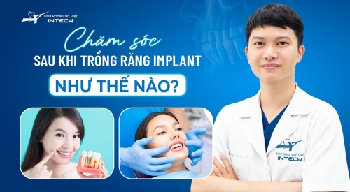 Chăm sóc răng sau khi trồng Implant như thế nào đúng cách?