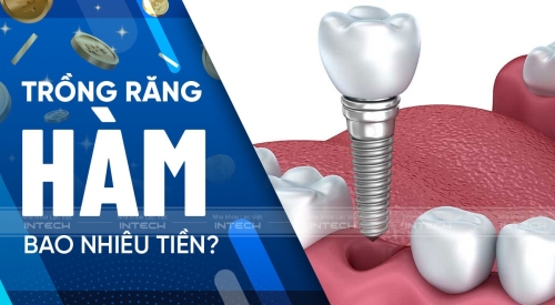 Trồng răng hàm giá bao nhiêu tiền? Cập nhật bảng giá đầy đủ mới nhất 2023