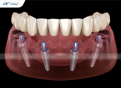 Trồng răng Implant All On 4 là gì? Áp dụng cho trường hợp nào?