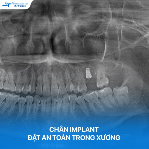 Bác sĩ giải đáp: “Trồng răng Implant có chụp X-quang được không?”