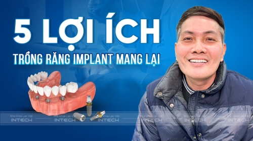 Lợi ích khi trồng răng implant là gì? Có gì khác với các phương pháp truyền thống?