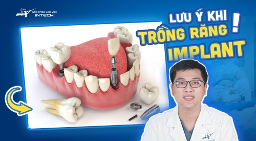 TOP 4 lưu ý sau khi trồng răng Implant giúp kết quả trồng răng lâu dài