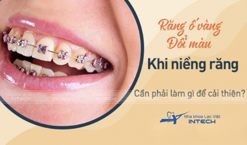 Nguyên nhân, giải pháp chữa niềng răng bị ố vàng triệt để