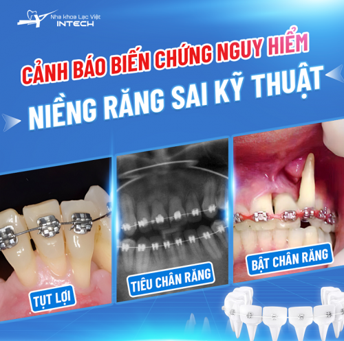 Có nên niềng răng không? Những sự thật có thể bạn chưa biết về niềng răng!