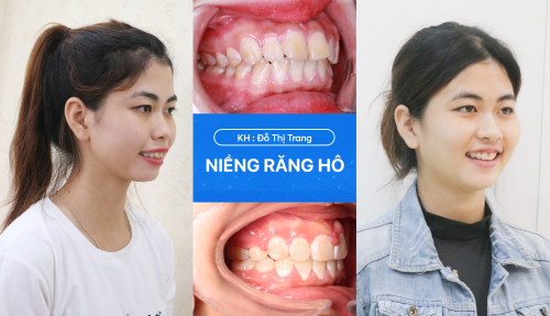 Bác sĩ Mai Anh (Nha khoa Lạc Việt Intech) là đại diện duy nhất của Việt Nam trong hạng mục Rising Star Speakers tại Hội nghị Chỉnh nha châu Á - Thái Bình Dương 2026 (APOC 2026)