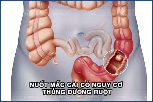 Nuốt phải dây cung niềng răng sao không? Xử lý thế nào?