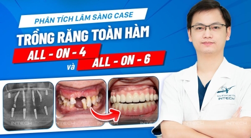 Phân tích lâm sàng ca mất nhiều răng 2 hàm, răng xô lệch và sai khớp cắn