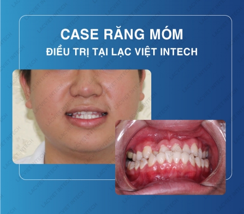 Quy trình niềng răng móm 6 bước cải thiện thẩm mỹ khuôn mặt