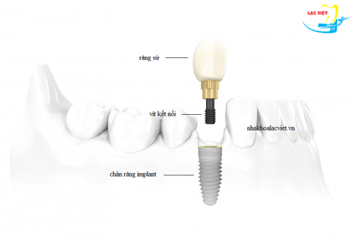 RĂNG IMPLANT BỊ LUNG LAY, NGUYÊN NHÂN VÀ CÁCH KHẮC PHỤC