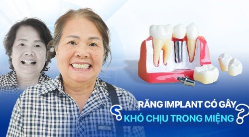 Hỏi đáp thắc mắc răng Implant gây khó chịu trong miệng không? 