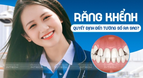 Răng khểnh đẹp hay xấu? Tướng số răng khểnh nói lên điều gì?
