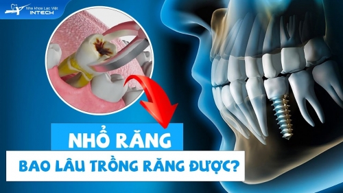 Nhổ Răng Bao Lâu Thì Trồng Lại Răng Được? 3 Yếu Tố Xác Định Nhổ Răng Bao Lâu Thì Trồng Lại Răng Được