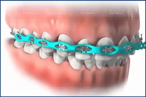 Thun chuỗi niềng răng và những điều cần biết trước khi sử dụng