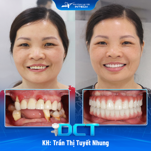 KH: Trần Thị Tuyết Nhung