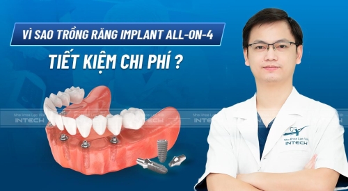 Vì sao trồng răng Implant toàn hàm All on 4 tiết kiệm chi phí?