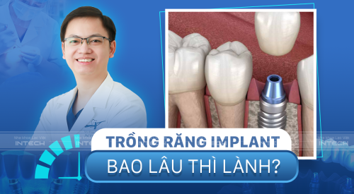 trồng răng implant bao lâu thì lành