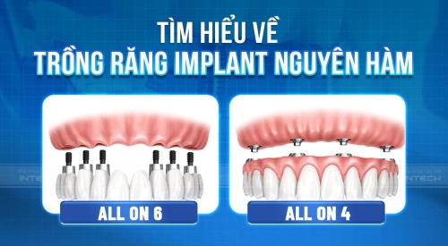 Kỹ thuật trồng răng Implant toàn hàm All-on-4 và All-on 6 tốt nhất hiện nay