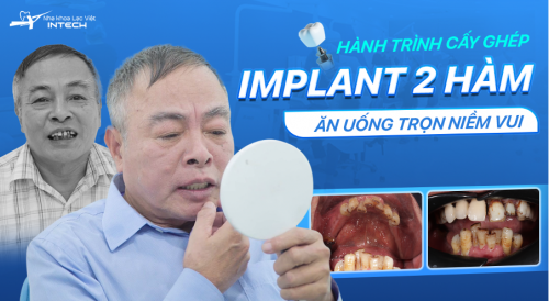 Hành trình cấy Implant toàn 2 hàm - Yên tâm ăn uống, trọn vẹn niềm vui