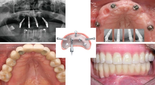 Trồng Răng Implant Nguyên Hàm: 6 Bí Mật Khủng Khiếp