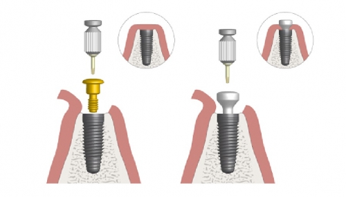 Trụ lành thương trong cấy ghép implant và những điều cần biết.