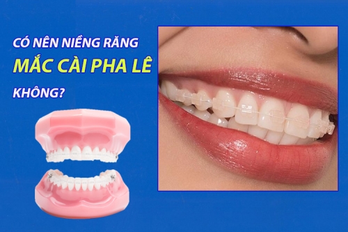 Có nên niềng răng mắc cài pha lê không?