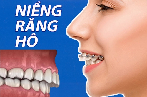 Giải đáp 5 vấn đề thường gặp về niềng răng hô