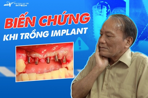 BIẾN CHỨNG CỦA TRỒNG RĂNG IMPLANT