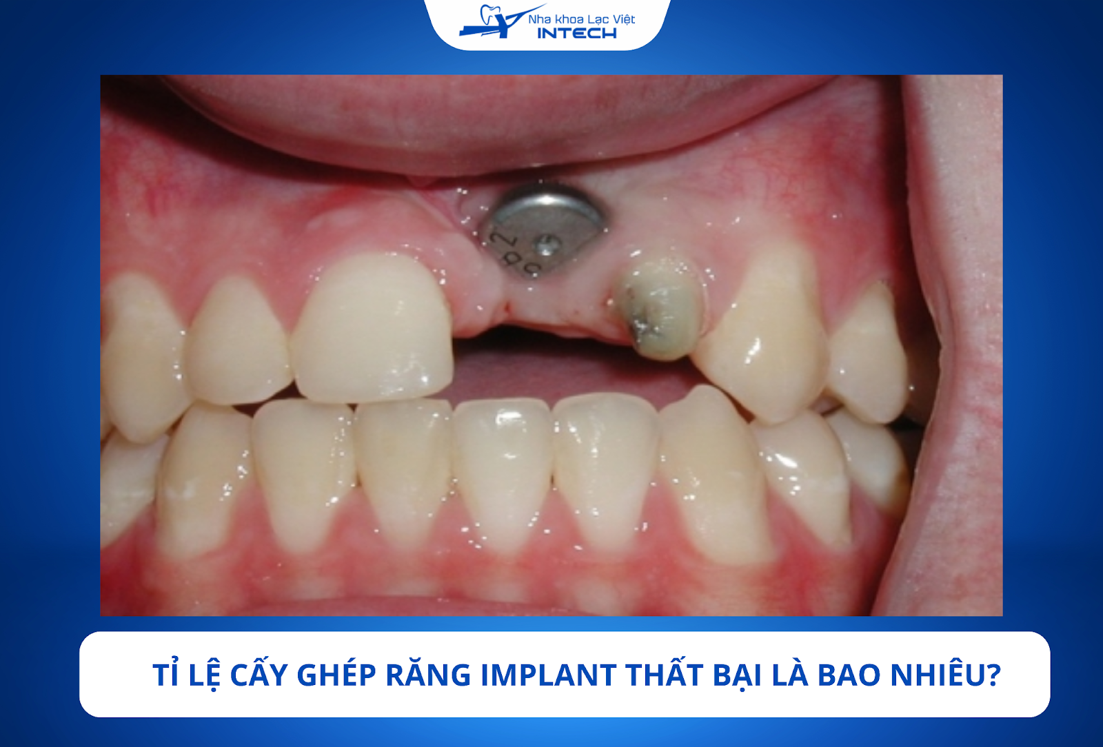 Hé lộ tỉ lệ cấy ghép răng Implant thành công và thất bại