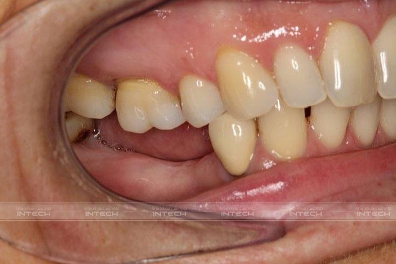 Tình trạng tiêu xương do mất răng lâu ngày ảnh hưởng tới thời gian cấy Implant