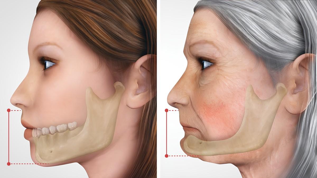 Hình ảnh mô phỏng tình trạng tiêu xương hàm nghiêm trọng và hạ thấp xoang hàm sau khi mất răng toàn hàm lâu năm.