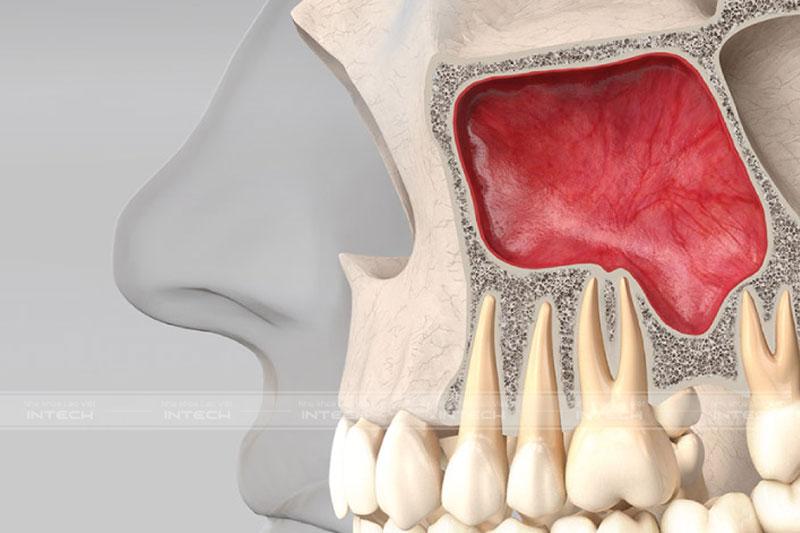 Tiêu xương hàm trên khiến xoang hàm hạ thấp không có đủ chỗ để đặt Implant
