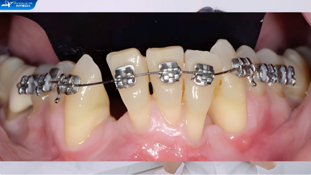 Tiêu xương khi niềng răng