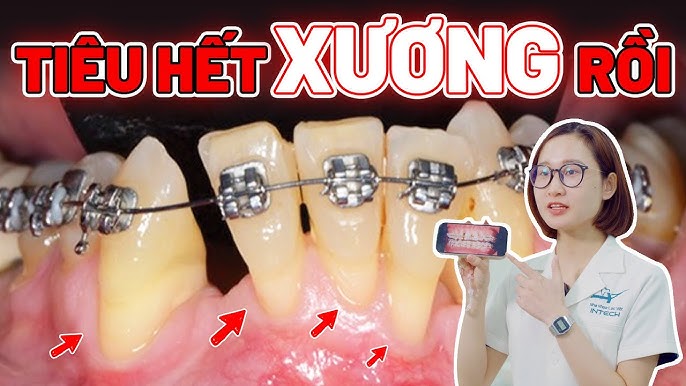 Tiêu Xương Khi Niềng Răng - 4 Nguyên Nhân Và Cách Phòng Tránh Triệt Để