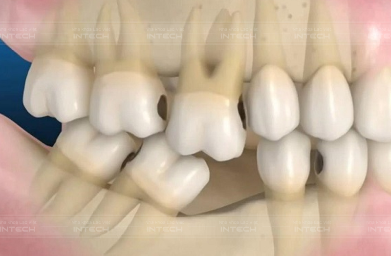 Mất răng lâu ngày khiến vùng xương bị tiêu biến