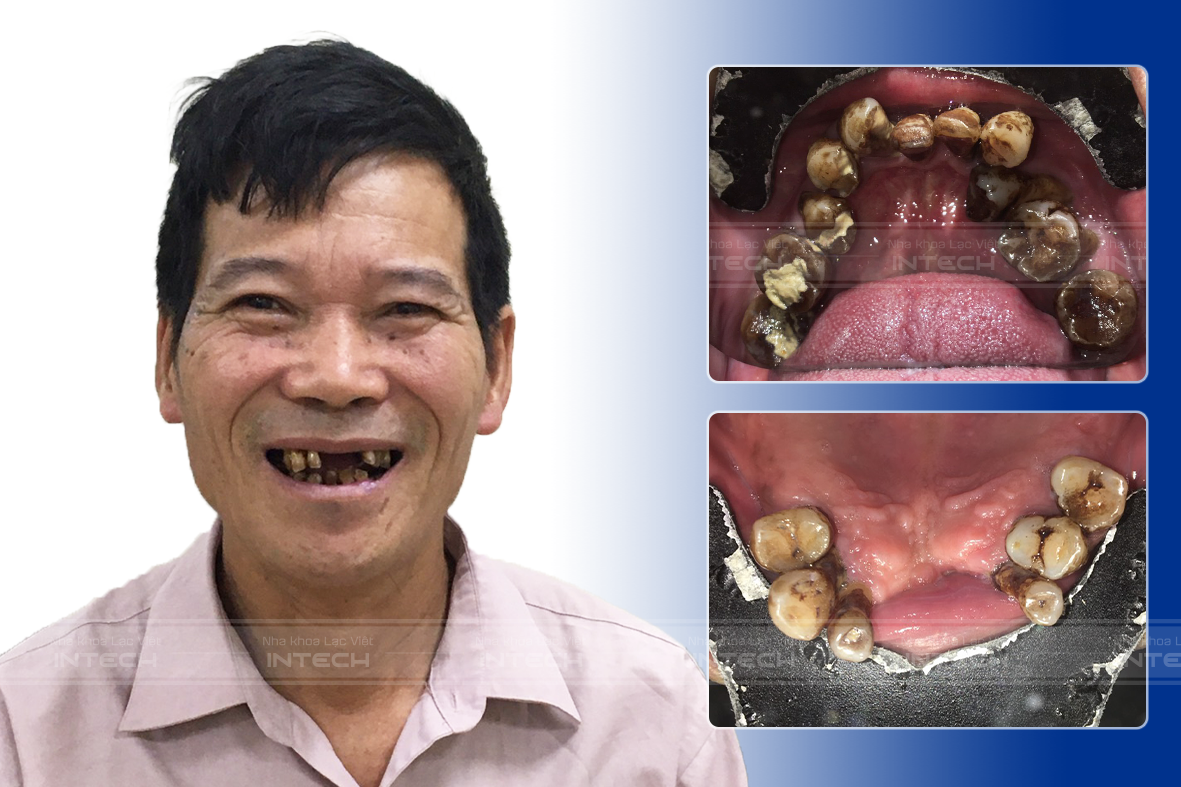 Tình trạng 2 hàm răng trước đây của chú Nguyễn Đức Tính