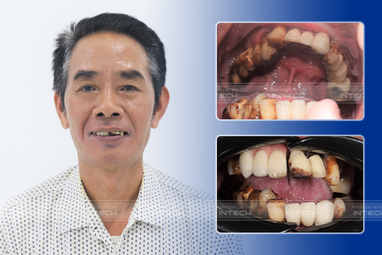 Hình ảnh tình trạng răng trước của chú Nguyễn Đức Hà