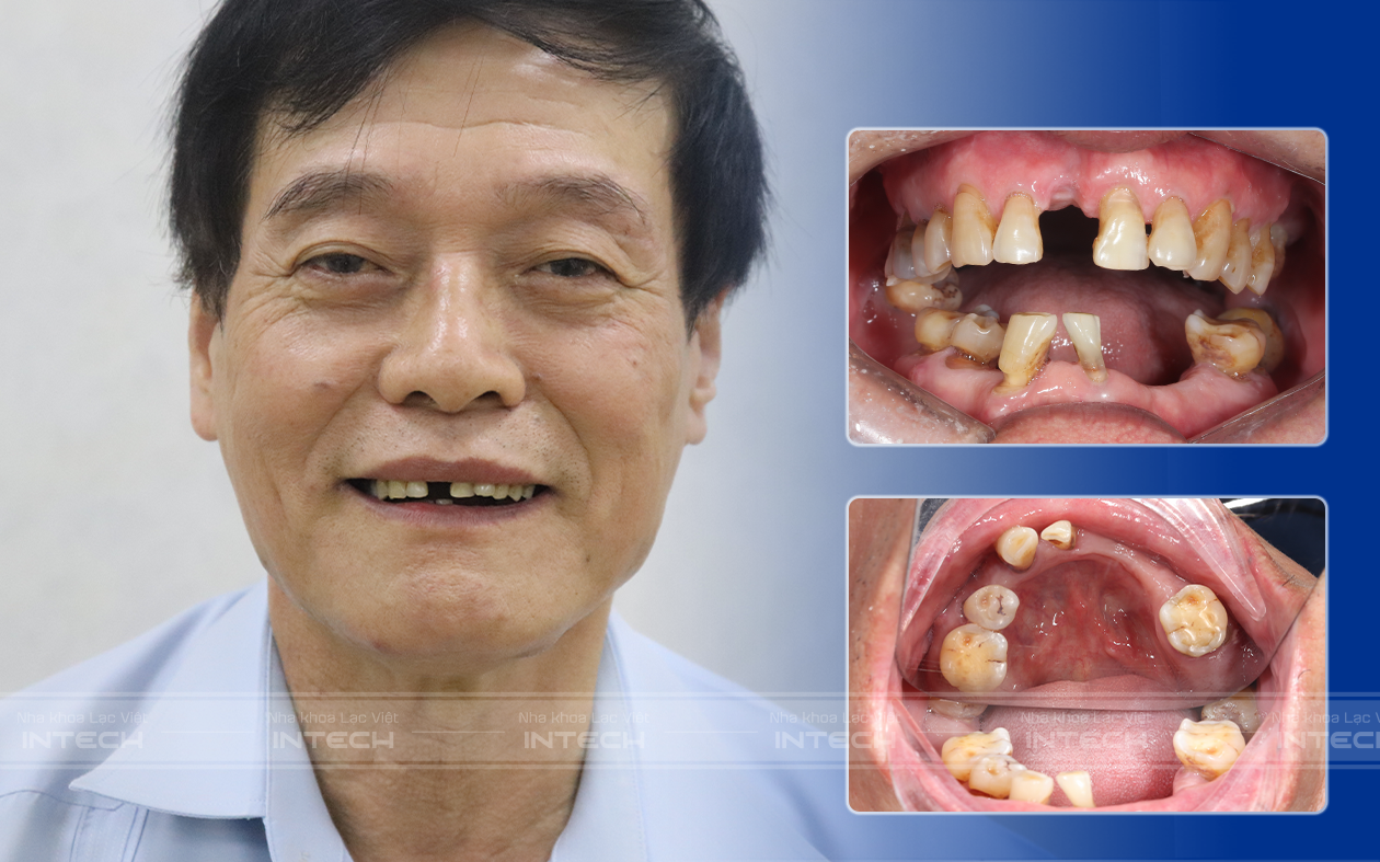 Tình trạng mất răng cửa hàm trên và nhiều răng hàm dưới của chú Lý