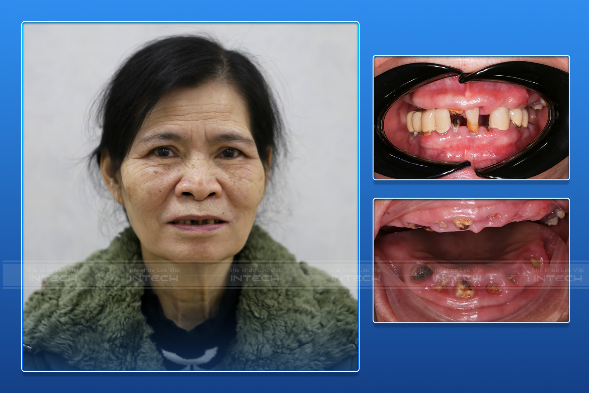 Tình trạng mất răng toàn hàm trên, hàm dưới làm răng sứ hỏng của cô Tô Thị Hải