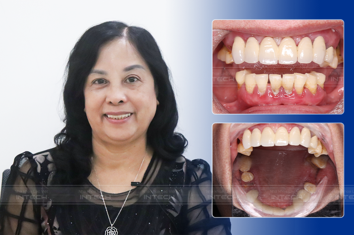 Tình trạng răng trước đây của cô Đỗ Thị Minh Cầm
