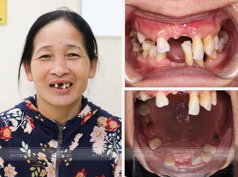 Tình trạng răng trước đây của cô Nguyễn Thị Thủy