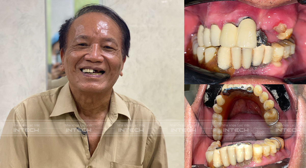 Tình trạng răng trước của chú Nguyễn Văn Toán